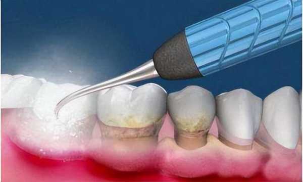 洗牙的过程（洗牙的过程中会出血吗）-图1