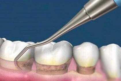 洗牙的过程（洗牙的过程中会出血吗）-图3