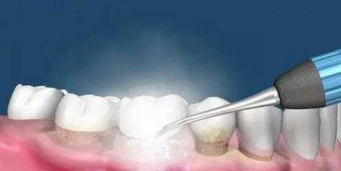 洗牙的过程（洗牙的过程中会出血吗）-图2