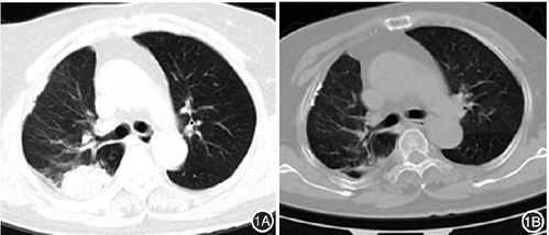 肺白化过程（肺部白化多长时间恢复）-图3
