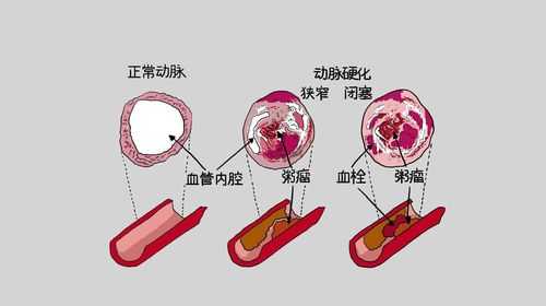 冠状动脉粥样硬化过程（冠状动脉粥样硬化过程图）-图1