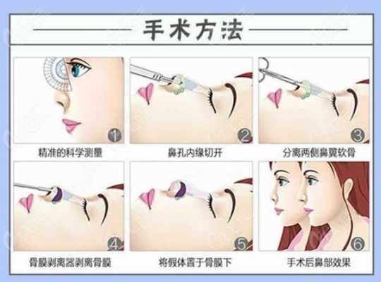 大综合隆鼻恢复过程（大综合鼻子手术包括哪些项目）-图1