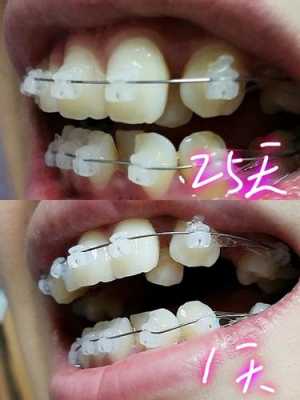 矫正牙齿的整个过程图（矫正牙齿的整个过程图片大全）-图2