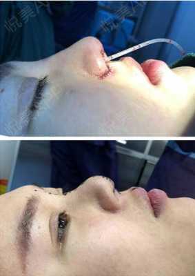 垫鼻梁手术过程（垫鼻梁手术过程教学）-图1