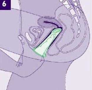 避孕仔细过程（避孕仔细过程图片）-图3