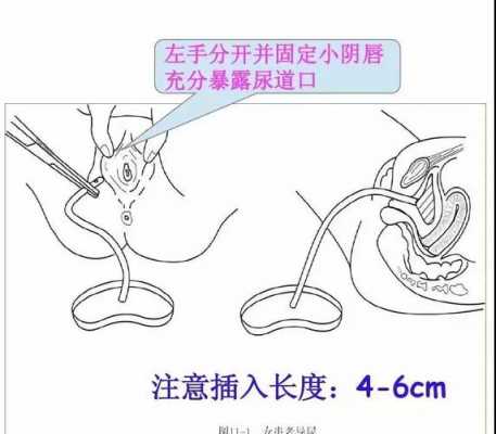 女性尿道插管过程（尿道插管有多痛）-图1