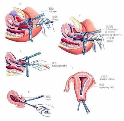 清宫术的过程（清宫术是怎么操作的流程）-图3