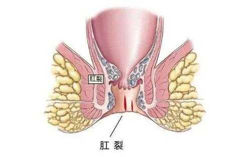 肛裂的检查过程（肛裂检查方法）-图3
