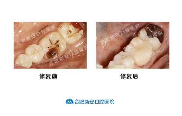 牙根填充过程（牙根填充是补牙吗）-图2