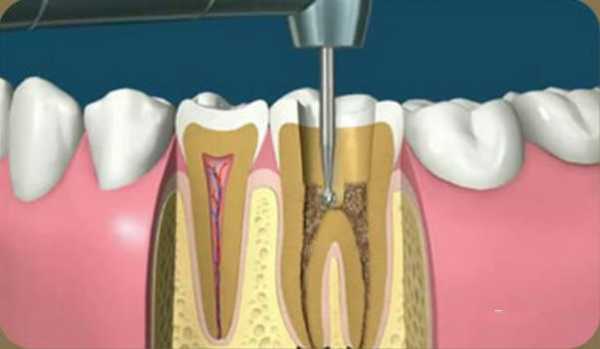 牙根填充过程（牙根填充是补牙吗）-图1