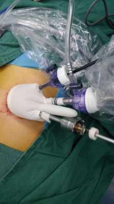 腔镜手术过程（腔镜手术过程中气腹压流量防止肿瘤）-图2