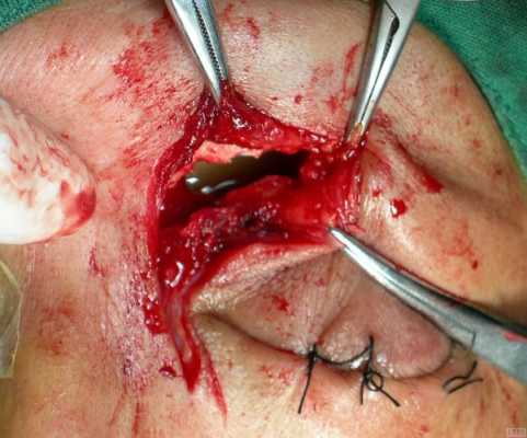 鼻子囊肿手术过程（鼻子囊肿手术过程图解）-图1