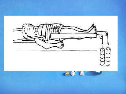 骨牵引过程（骨牵引的视频）-图1
