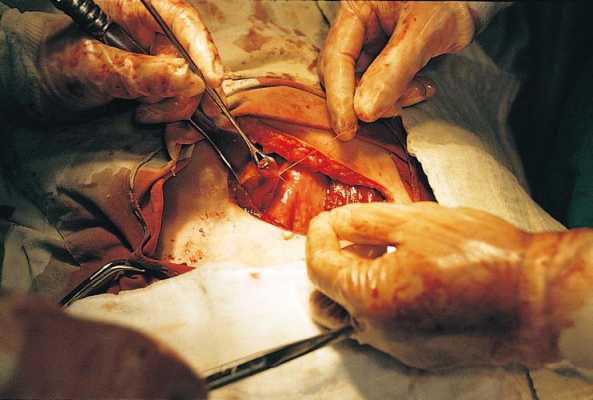 开刀手术过程（开刀手术过程图）-图1
