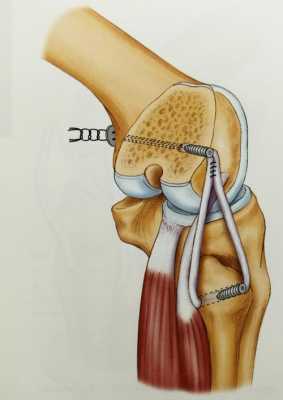韧带修复过程（韧带修复过程的感觉?）-图2