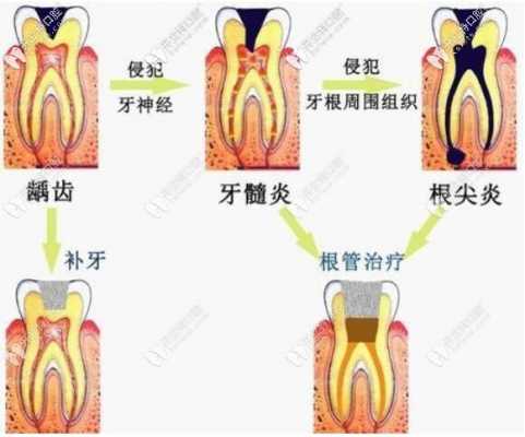 深龋齿治疗过程（深龋治疗方案的选择）-图3