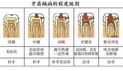 深龋齿治疗过程（深龋治疗方案的选择）-图2
