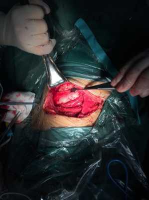 开胸手术闭合过程（开胸手术闭合过程视频）-图2