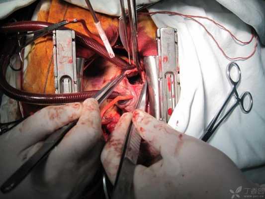 开胸手术闭合过程（开胸手术闭合过程视频）-图3