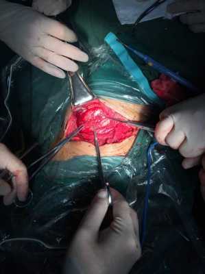 开胸手术闭合过程（开胸手术闭合过程视频）-图1