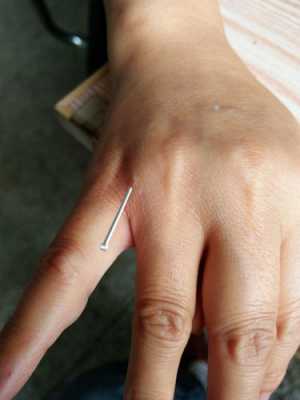 针刺小指的过程（针灸扎小拇指治什么病）-图1