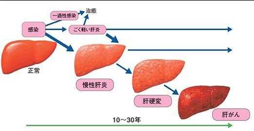 肝炎损伤的过程（肝炎损伤的过程是怎样的）-图2