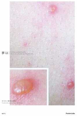 水痘的愈合过程图片（水痘的愈合的过程）-图2