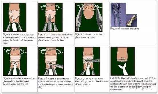 包皮套环术的过程（包皮套环手术流程）-图3