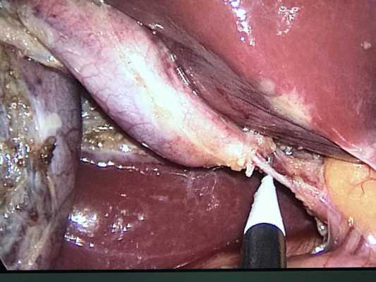 胆囊切除术过程（胆囊切除术过程图片）-图2