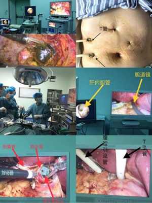 胆囊切除术过程（胆囊切除术过程图片）-图1