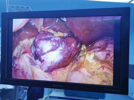 肝血管瘤开腹手术过程（肝血管瘤开腹手术过程视频）-图3