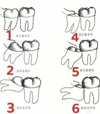 长智齿的过程图片（长智齿的过程图片）-图2