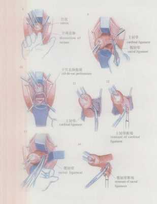子宫切除术的过程准备（子宫切除手术过程）-图3