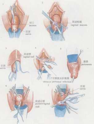 子宫切除术的过程准备（子宫切除手术过程）-图2