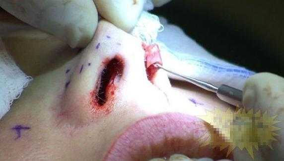 隆鼻手术过程（隆鼻手术过程会睡着吗）-图1