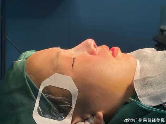 隆鼻手术过程（隆鼻手术过程会睡着吗）-图2
