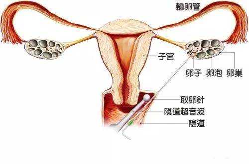 阴道后穹窿穿刺过程的简单介绍-图2