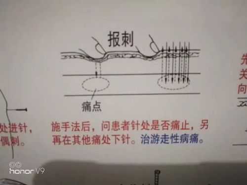 针刺过程图片（针刺的过程步骤）-图1