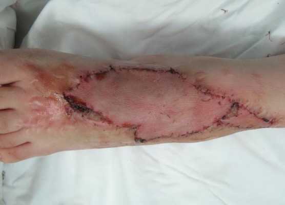 人造植皮过程（人造皮肤植皮手术）-图2