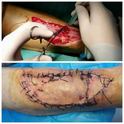 人造植皮过程（人造皮肤植皮手术）-图3