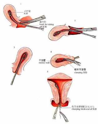 妇女带环过程图片（妇女带环过程图片大全）-图1