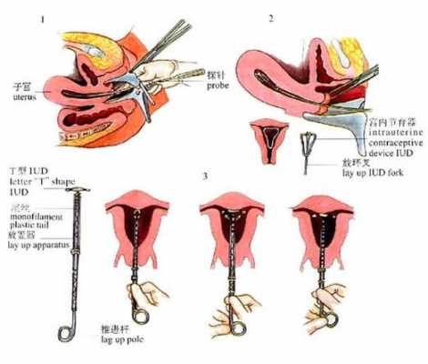 妇女带环过程图片（妇女带环过程图片大全）-图2