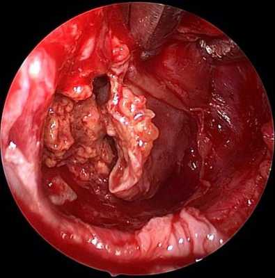 颅咽管瘤手术过程（颅咽管瘤手术风险）-图2