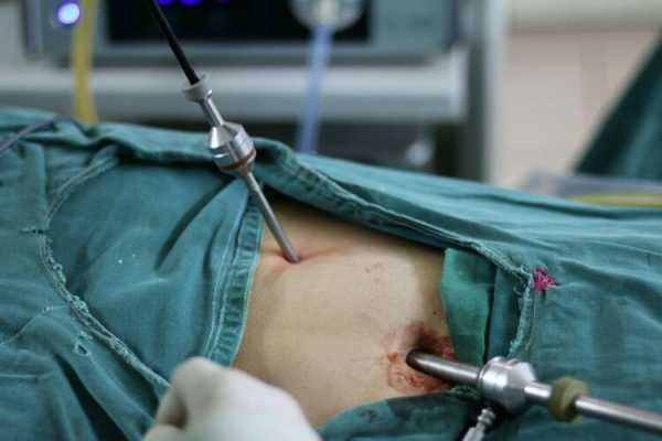 腹腔镜阑尾炎手术过程（腹腔镜阑尾炎手术过程中能看到哪些其他器官）-图1