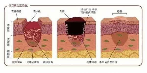 人体皮肤愈合过程（皮肤愈合周期是多久）-图3
