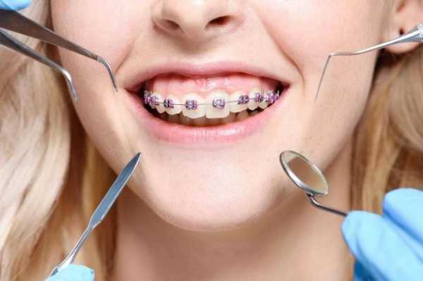 绑牙齿的过程（绑牙齿过程要多久）-图1
