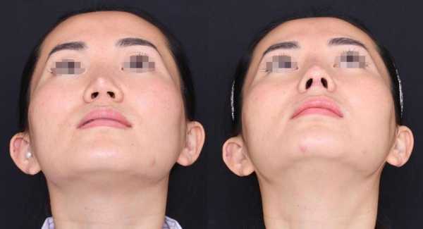 硅胶隆鼻过程（硅胶隆鼻过程图片）-图1