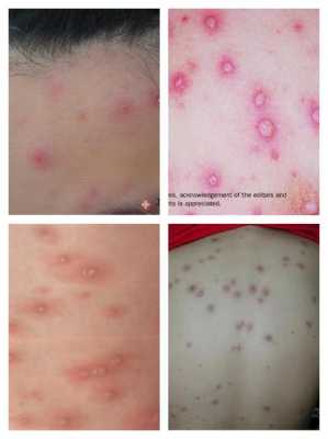 水痘的病变过程（水痘的病变过程图片）-图3