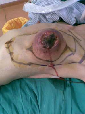 乳癌切除过程（乳癌切除过程图片）-图1