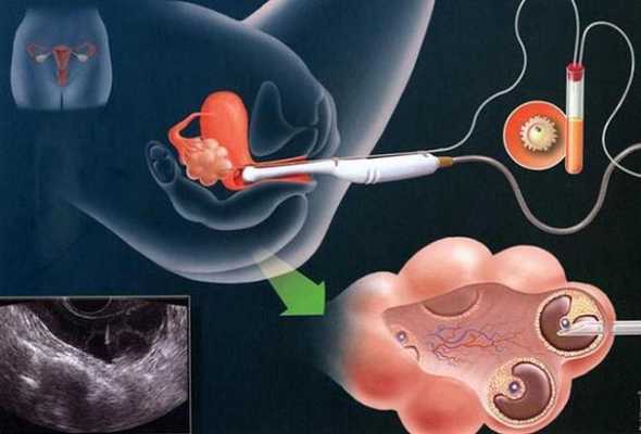 做试管婴儿的过程（做试管婴儿的过程中阳过,胚胎会有影响吗?）-图3